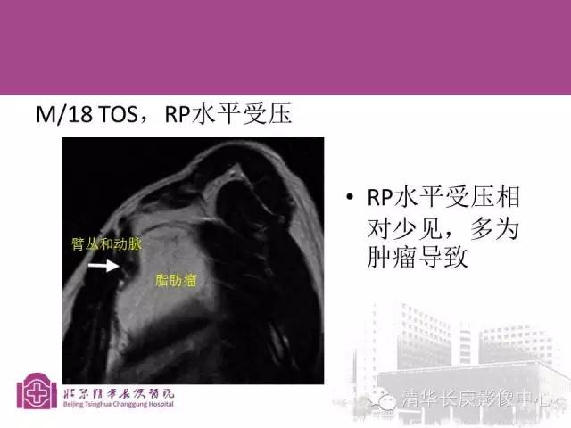 【PPT】臂丛的MR成像