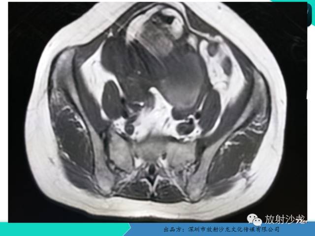 【病例】卵巢畸胎瘤1例MR影像诊断与鉴别