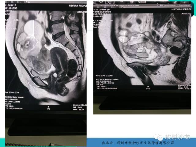 【病例】卵巢畸胎瘤1例MR影像诊断与鉴别