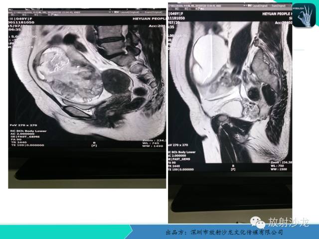 【病例】卵巢畸胎瘤1例MR影像诊断与鉴别