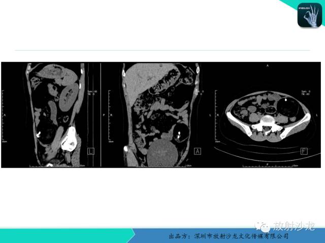 【病例】卵巢畸胎瘤1例MR影像诊断与鉴别