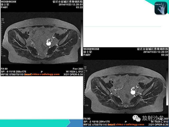 【病例】卵巢畸胎瘤1例MR影像诊断与鉴别