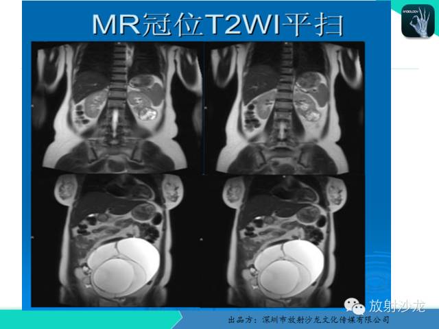 【病例】卵巢畸胎瘤1例MR影像诊断与鉴别