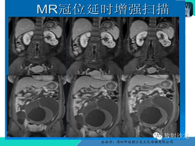 【病例】卵巢畸胎瘤1例MR影像诊断与鉴别