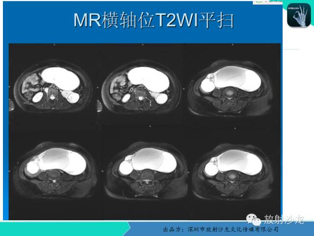【病例】卵巢畸胎瘤1例MR影像诊断与鉴别