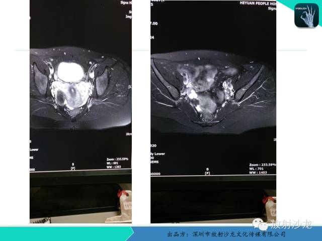 【病例】卵巢畸胎瘤1例MR影像诊断与鉴别