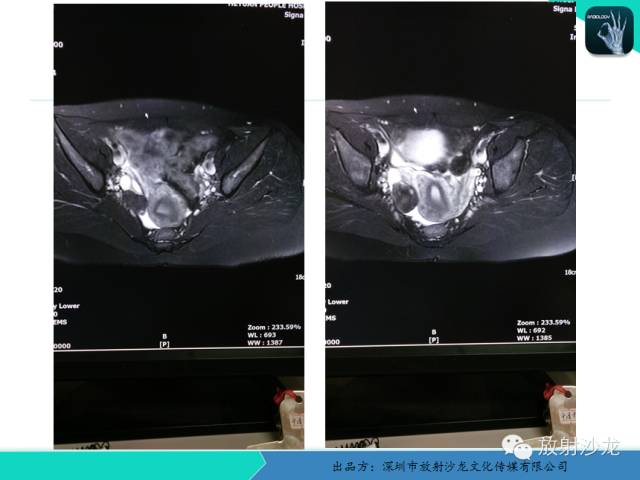 【病例】卵巢畸胎瘤1例MR影像诊断与鉴别