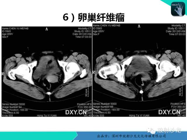 【病例】卵巢畸胎瘤1例MR影像诊断与鉴别
