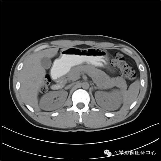 【病例】胰腺实性假乳头状瘤1例CT影像表现与鉴别