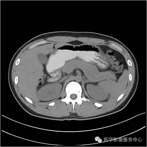 【病例】胰腺实性假乳头状瘤1例CT影像表现与鉴别 【病例】胰腺实性假乳头状瘤1例CT影像表现与鉴别