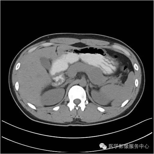 【病例】胰腺实性假乳头状瘤1例CT影像表现与鉴别 【病例】胰腺实性假乳头状瘤1例CT影像表现与鉴别