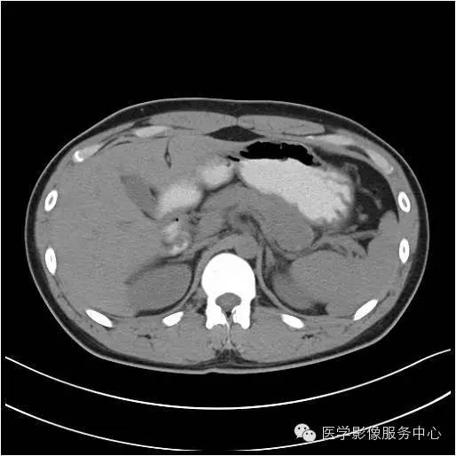 【病例】胰腺实性假乳头状瘤1例CT影像表现与鉴别 【病例】胰腺实性假乳头状瘤1例CT影像表现与鉴别