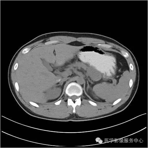 【病例】胰腺实性假乳头状瘤1例CT影像表现与鉴别 【病例】胰腺实性假乳头状瘤1例CT影像表现与鉴别
