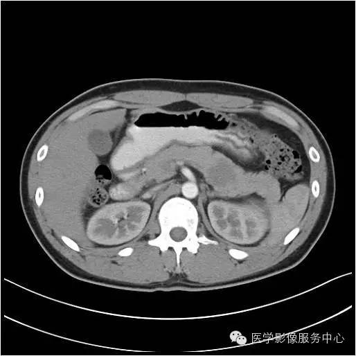 【病例】胰腺实性假乳头状瘤1例CT影像表现与鉴别 【病例】胰腺实性假乳头状瘤1例CT影像表现与鉴别