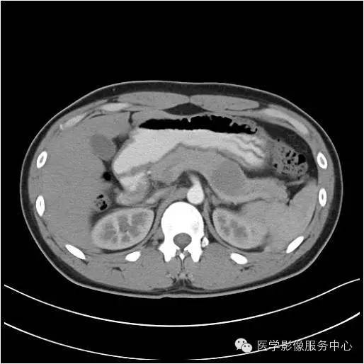 【病例】胰腺实性假乳头状瘤1例CT影像表现与鉴别 【病例】胰腺实性假乳头状瘤1例CT影像表现与鉴别