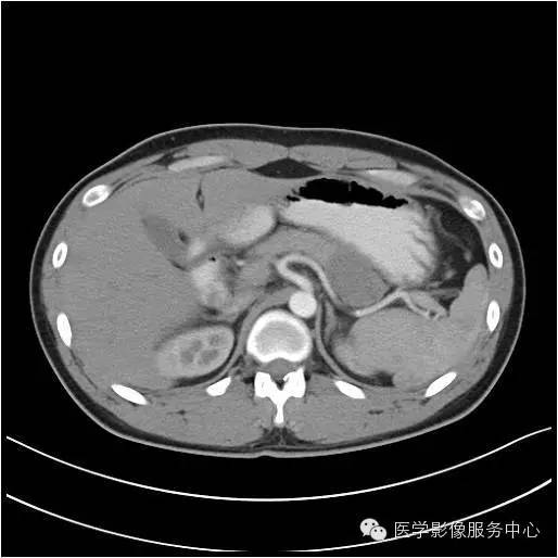 【病例】胰腺实性假乳头状瘤1例CT影像表现与鉴别 【病例】胰腺实性假乳头状瘤1例CT影像表现与鉴别