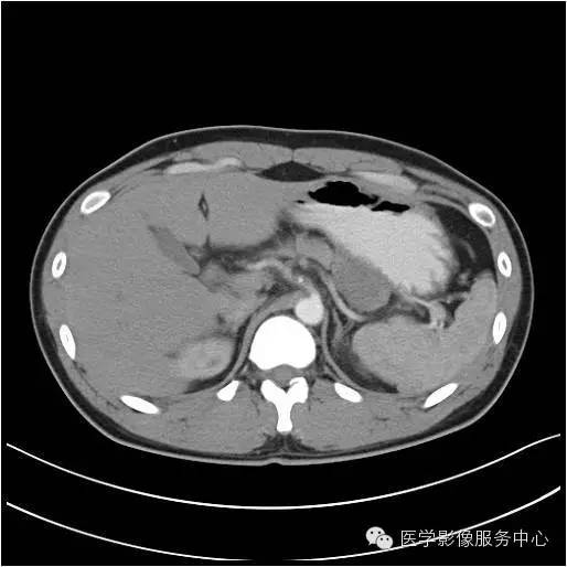【病例】胰腺实性假乳头状瘤1例CT影像表现与鉴别 【病例】胰腺实性假乳头状瘤1例CT影像表现与鉴别