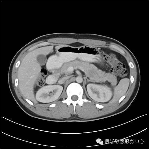 【病例】胰腺实性假乳头状瘤1例CT影像表现与鉴别 【病例】胰腺实性假乳头状瘤1例CT影像表现与鉴别