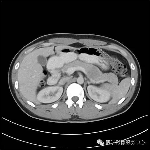 【病例】胰腺实性假乳头状瘤1例CT影像表现与鉴别 【病例】胰腺实性假乳头状瘤1例CT影像表现与鉴别