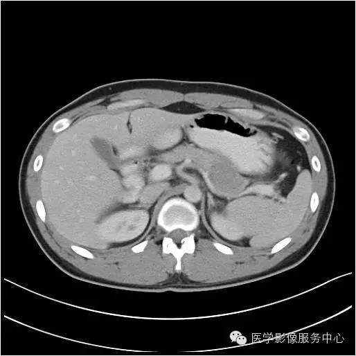【病例】胰腺实性假乳头状瘤1例CT影像表现与鉴别 【病例】胰腺实性假乳头状瘤1例CT影像表现与鉴别