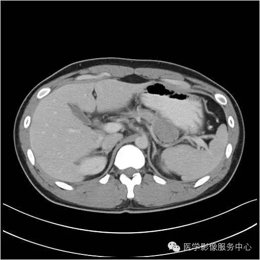 【病例】胰腺实性假乳头状瘤1例CT影像表现与鉴别 【病例】胰腺实性假乳头状瘤1例CT影像表现与鉴别