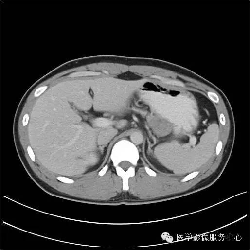【病例】胰腺实性假乳头状瘤1例CT影像表现与鉴别 【病例】胰腺实性假乳头状瘤1例CT影像表现与鉴别