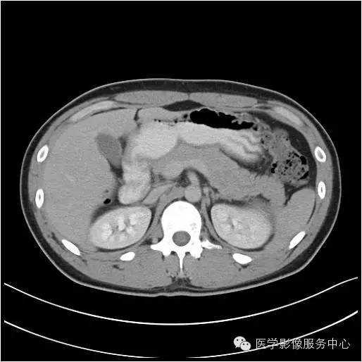【病例】胰腺实性假乳头状瘤1例CT影像表现与鉴别 【病例】胰腺实性假乳头状瘤1例CT影像表现与鉴别
