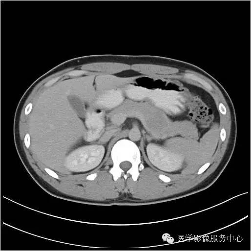 【病例】胰腺实性假乳头状瘤1例CT影像表现与鉴别 【病例】胰腺实性假乳头状瘤1例CT影像表现与鉴别