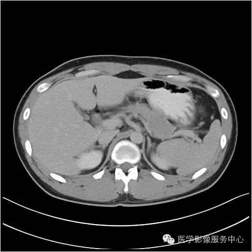 【病例】胰腺实性假乳头状瘤1例CT影像表现与鉴别 【病例】胰腺实性假乳头状瘤1例CT影像表现与鉴别