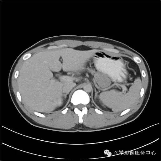 【病例】胰腺实性假乳头状瘤1例CT影像表现与鉴别 【病例】胰腺实性假乳头状瘤1例CT影像表现与鉴别