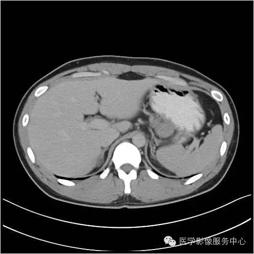 【病例】胰腺实性假乳头状瘤1例CT影像表现与鉴别 【病例】胰腺实性假乳头状瘤1例CT影像表现与鉴别