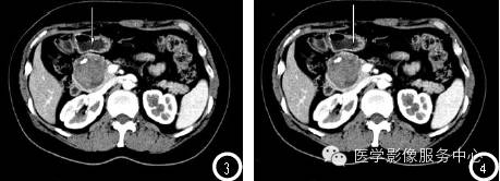 【病例】胰腺实性假乳头状瘤1例CT影像表现与鉴别 【病例】胰腺实性假乳头状瘤1例CT影像表现与鉴别