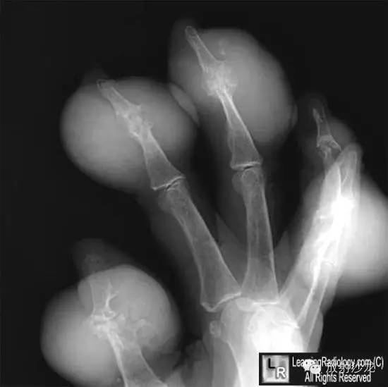 【病例】痛风1例X线影像表现 【病例】痛风1例X线影像表现