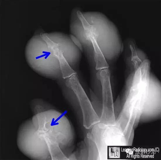 【病例】痛风1例X线影像表现 【病例】痛风1例X线影像表现