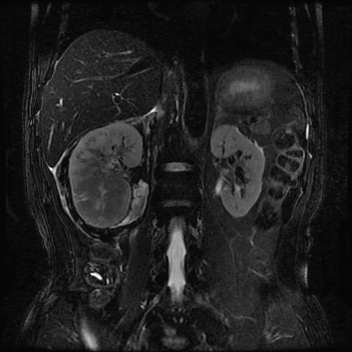 【病例】肾肉瘤样癌1例MR影像表现 【病例】肾肉瘤样癌1例MR影像表现