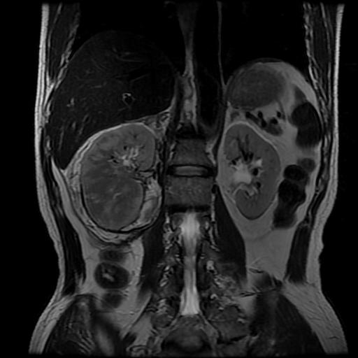 【病例】肾肉瘤样癌1例MR影像表现 【病例】肾肉瘤样癌1例MR影像表现