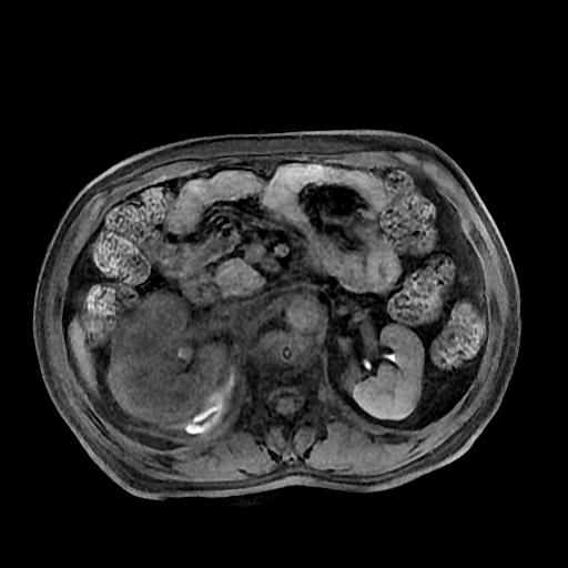 【病例】肾肉瘤样癌1例MR影像表现 【病例】肾肉瘤样癌1例MR影像表现