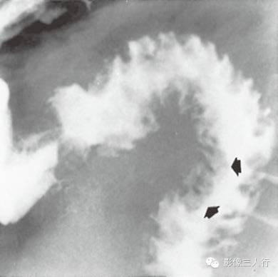 十二指肠乳头增大相关疾病及鉴别诊断