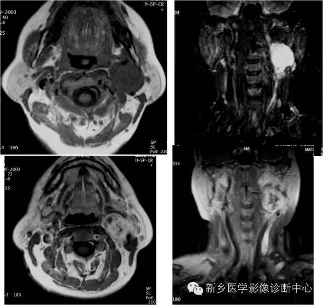 【病例】颈部囊性病变3例MR影像诊断与鉴别