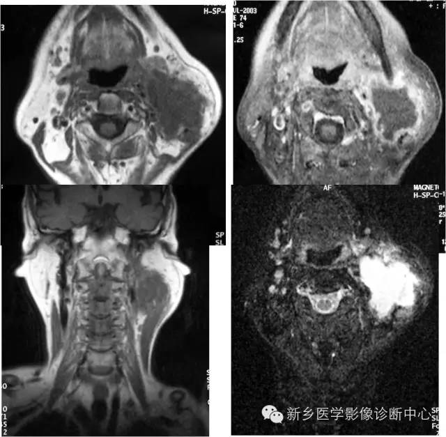 【病例】颈部囊性病变3例MR影像诊断与鉴别