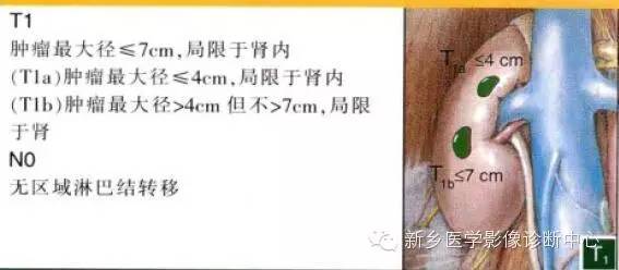肾癌的影像学分期及图解