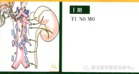 肾癌的影像学分期及图解