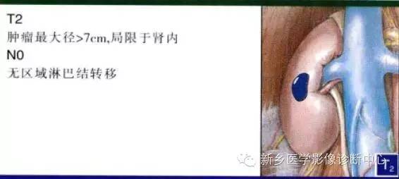 肾癌的影像学分期及图解