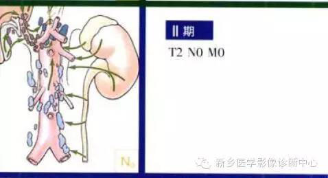 肾癌的影像学分期及图解