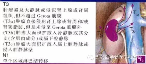 肾癌的影像学分期及图解