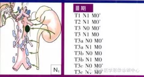 肾癌的影像学分期及图解