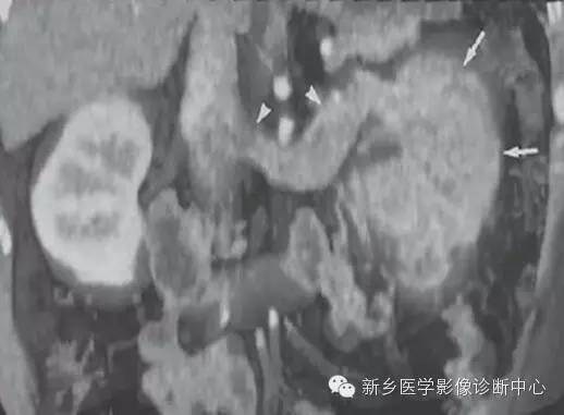 肾癌的影像学分期及图解
