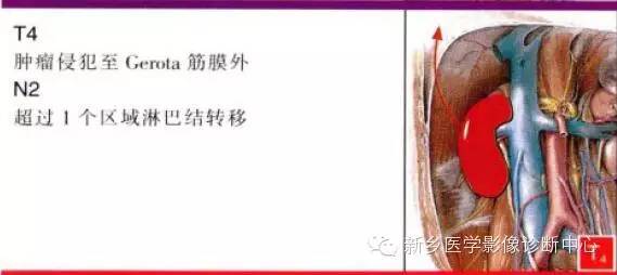 肾癌的影像学分期及图解