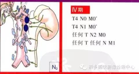 肾癌的影像学分期及图解