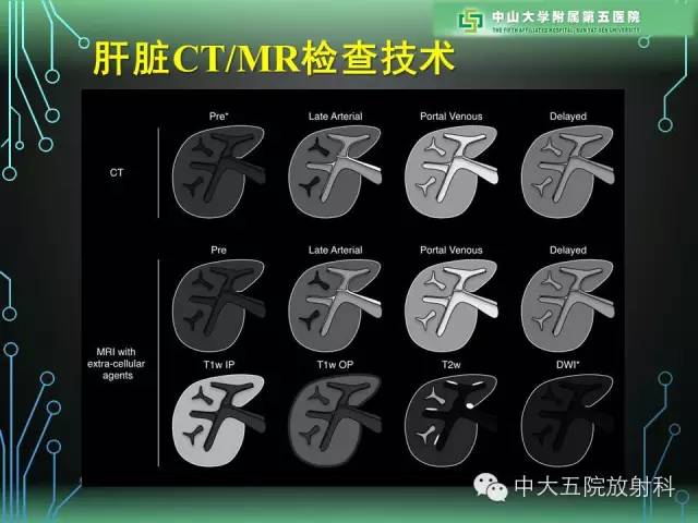 【PPT】肝癌高危患者肝脏结节影像学诊断